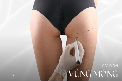 Căng chỉ vùng mông